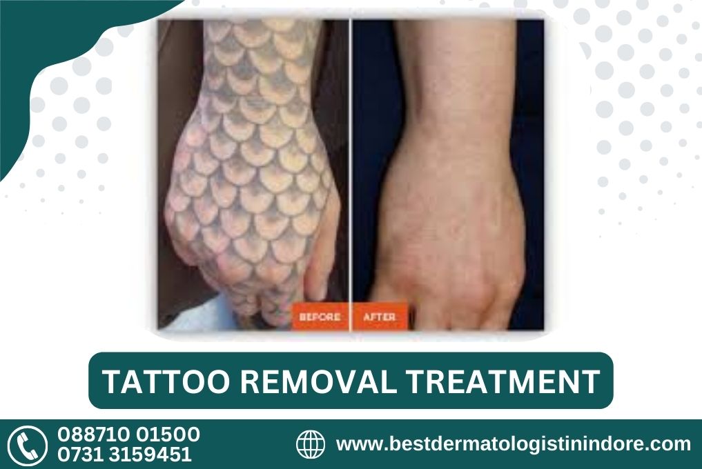 Top Doctor For Tattoo Removal In Ujjain